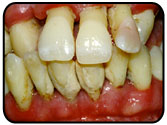 ADVANCED PERIODONTITIS 1