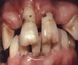 ADVANCED PERIODONTITIS 2