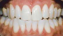 AFTER BLEACHING 1