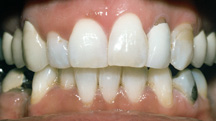 AFTER BLEACHING 2