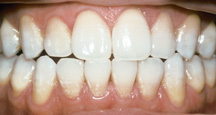 AFTER BLEACHING 3