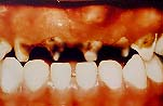 Affected Teeth