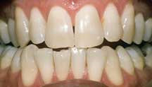 BEFORE BLEACHING 1