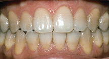 BEFORE BLEACHING 3