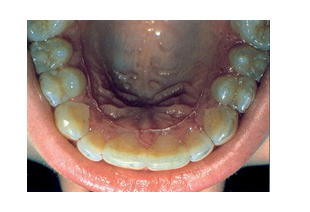 COMPLETE_DENTURES