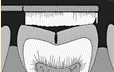 COMPLETE_DENTURES