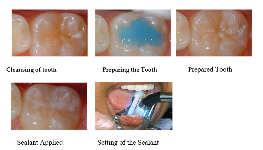 COMPLETE_DENTURES