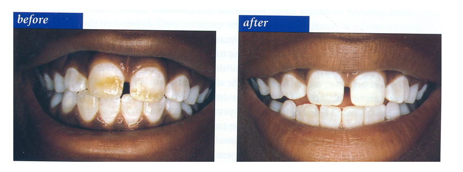 COMPLETE_DENTURES