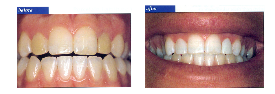 COMPLETE_DENTURES
