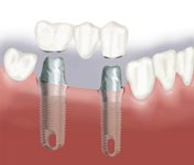 Eliminate a Partial Denture with several implants and a bridge.