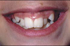 Malocclusion 1