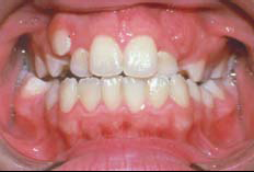 Malocclusion 2