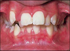 Malocclusion 3