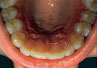 Mouthguard Bleaching