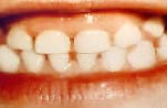 Normal Teeth