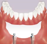 Retain an Overdenture with several implants.