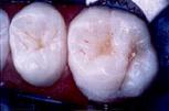 Sealants to Prevent Cavities 1