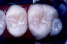 Sealants to Prevent Cavities 2