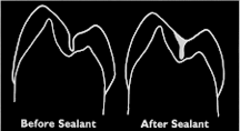 Sealants to Prevent Cavities 3