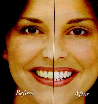 Tooth Whitening