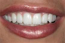 Veneers After
