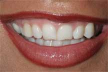Veneers Before
