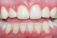 WHAT IS GINGIVITIS