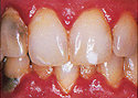WHAT IS PERIODONTAL DISEASE