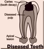 Diseased Tooth