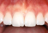 Healthy Gums
