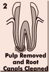 Pulp Removed And Root Canals Cleaned