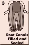 Root Canals Filled And Sealed